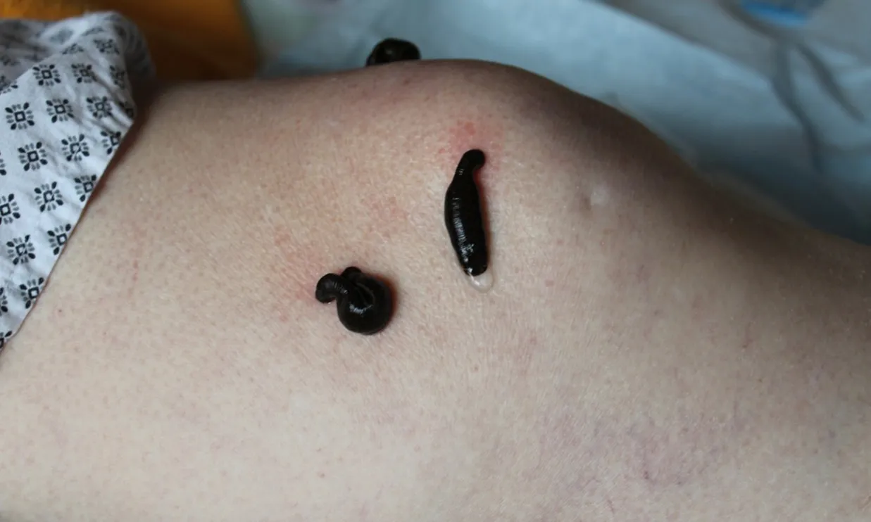 WHAT IS LEECH THERAPY
