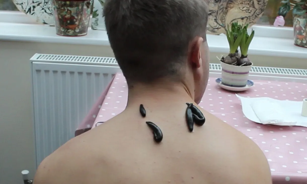 BENEFITS OF LEECH THERAPY